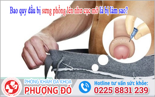 Bao quy đầu bị sưng phồng lên như cục mỡ là bị làm sao?