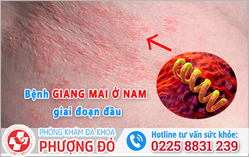 Triệu chứng bệnh giang mai ở nam giai đoạn đầu và Cách chữa trị