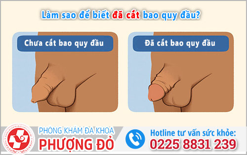 BS Chia Sẻ: Cách làm sao để biết đã cắt bao quy đầu?