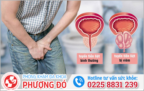 5 dấu hiệu phì đại tuyến tiền liệt giúp bạn nhận biết dễ dàng