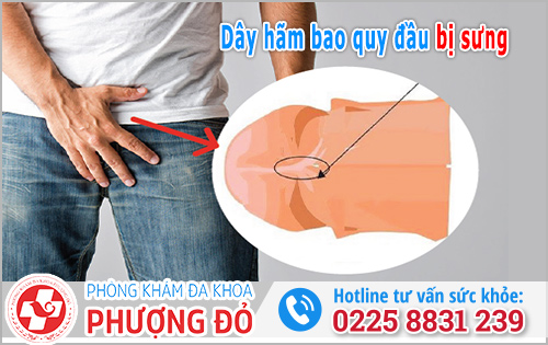 Dây hãm bao quy đầu bị sưng: Nguyên nhân, triệu chứng & cách xử lý
