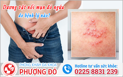 Dương vật nổi mụn đỏ ngứa do bệnh lý nào? Cách khắc phục