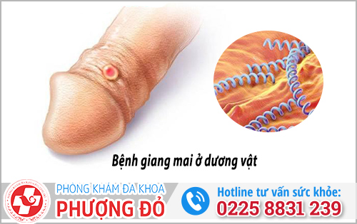 Dấu hiệu nhận biết giang mai dương vật và Cách chữa trị