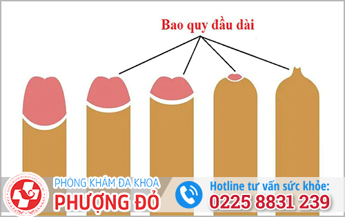 Làm sao để biết bao quy đầu dài?