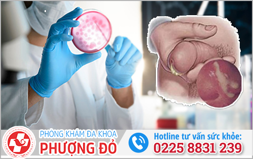 Lậu mãn tính có xét nghiệm được không? Cách phát hiện chính xác nhất