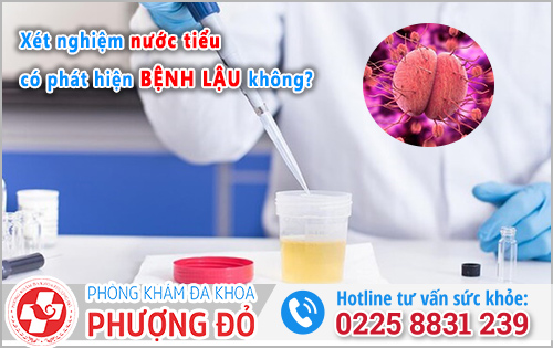 Nếu chỉ xét nghiệm nước tiểu có phát hiện bệnh lậu không?