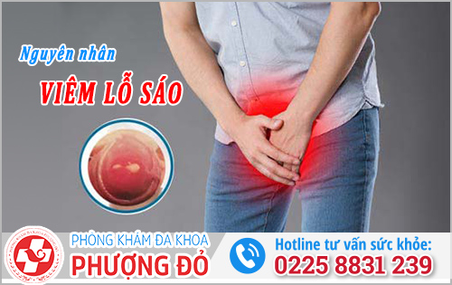 Nguyên nhân gây viêm lỗ sáo ở nam giới và Cách chữa trị