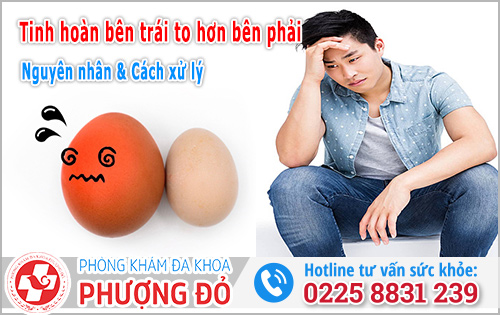 Tinh hoàn bên trái to hơn bên phải: Nguyên nhân và Cách xử lý