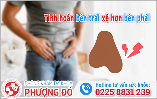 Tinh hoàn bên trái xệ hơn bên phải: Bình thường hay bệnh lý?