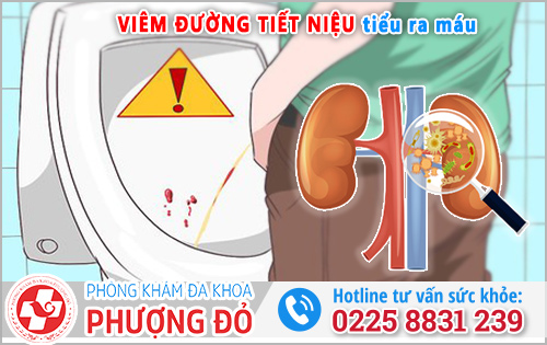 Viêm đường tiết niệu tiểu ra máu: Điều gì đang xảy ra?