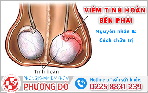 Viêm tinh hoàn bên phải: Nguyên nhân và Cách chữa trị
