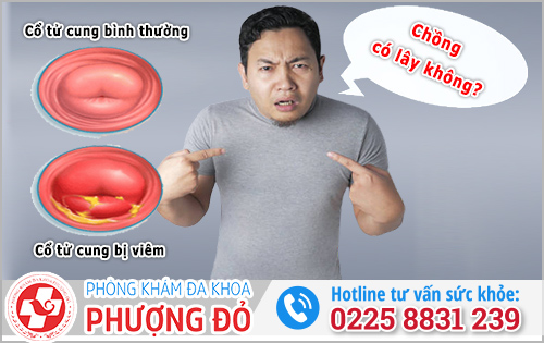 Vợ bị viêm lộ tuyến có lây sang chồng không? Giải đáp từ chuyên gia