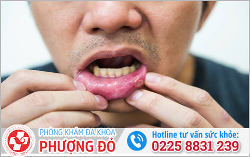 Nhận biết bệnh lậu lây qua nước bọt