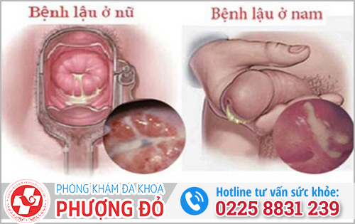 Biểu hiện bệnh lậu có ngứa không?