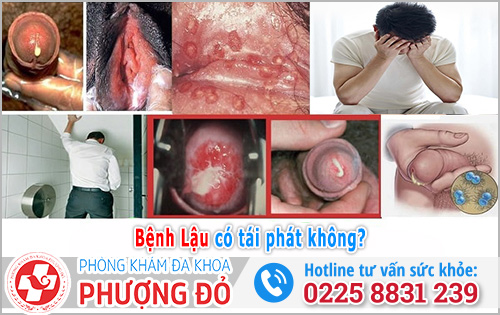 Bệnh Lậu có tái phát không?