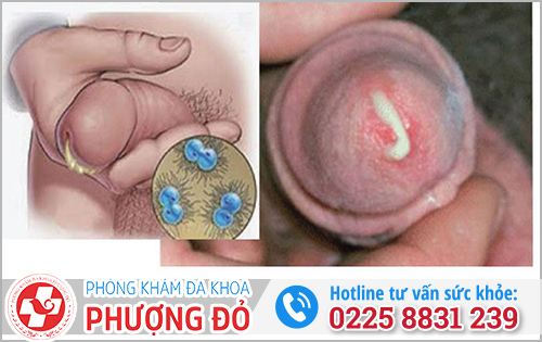 Dấu hiệu tái phát bệnh Lậu