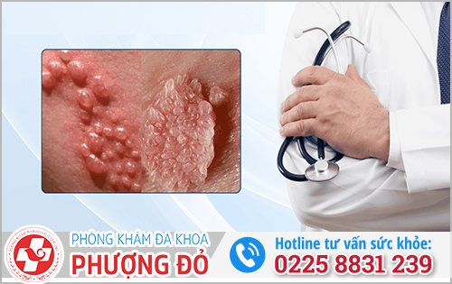 Cách xử lý khi bệnh lậu tái phát