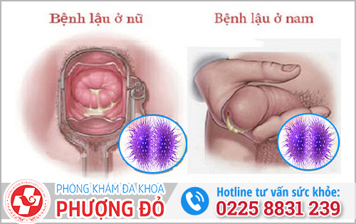 Những thông tin phải biết về bệnh Lậu