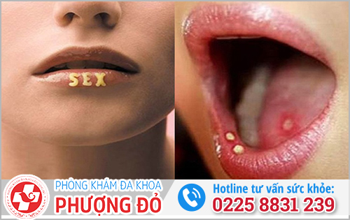 Những trường hợp dễ lây bệnh lậu khi quan hệ miệng