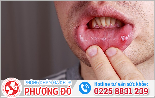 Lây bệnh lậu do quan hệ miệng có sao không?