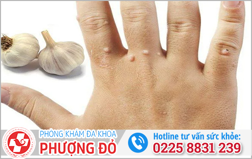 Mẹo dân gian hỗ trợ người bệnh lậu bằng tỏi