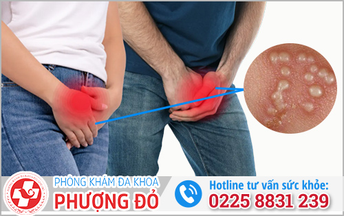 Sùi mào gà là gì?