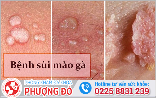 Thông tin về bệnh sùi mào gà