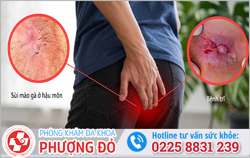 Những bệnh giống sùi mào gà