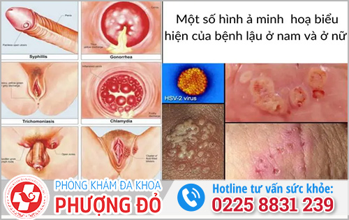 Dấu hiệu mắc bệnh lậu