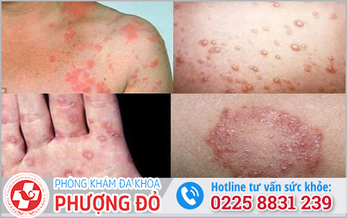 Biến chứng bệnh lậu thường xảy ra