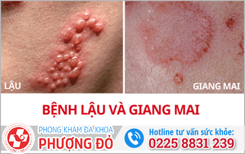 Bệnh lậu và bệnh giang mai khác nhau thế nào?