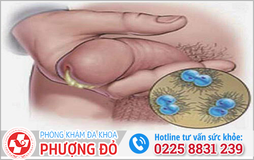 Tổng quan về bệnh lậu ở nam giới