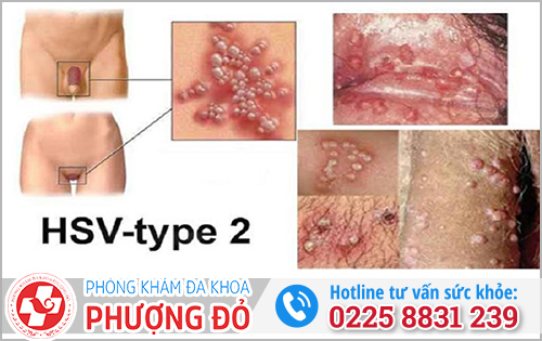 Điều trị mụn rộp sinh dục