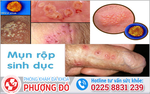 Triệu chứng của bệnh mụn rộp sinh dục ở nam giới