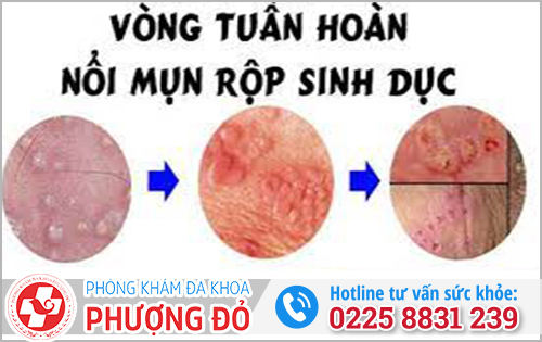 Biểu hiện của mụn rộp sinh dục