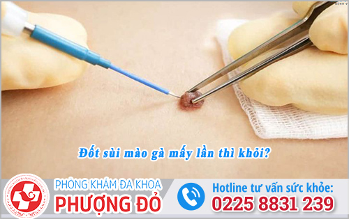 Đốt sùi mào gà mấy lần thì khỏi?