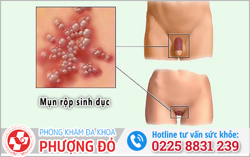 Tổng quan về bệnh mụn rộp sinh dục