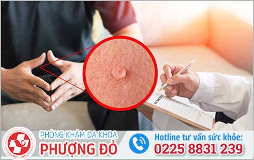 Chưa quan hệ có bị sùi mào gà không?