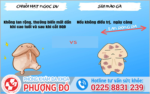 Cách phân biệt chuỗi hạt ngọc và sùi mào gà