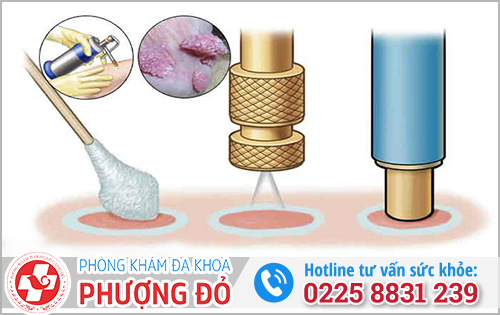 Sùi mào gà và chuỗi hạt ngọc