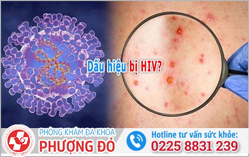Dấu hiệu bị HIV