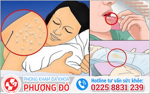 Dấu hiệu nhiễm HIV ban đầu ở nữ giới