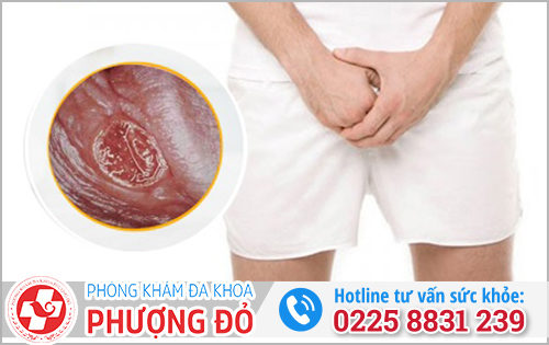 Hình ảnh bệnh giang mai ở dương vật