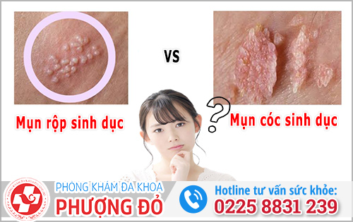 Mụn cóc sinh dục và mụn rộp sinh dục
