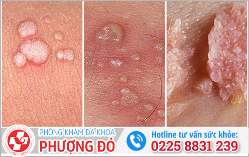 Mụn rộp sinh dục và mụn cóc sinh dục có giống nhau không?