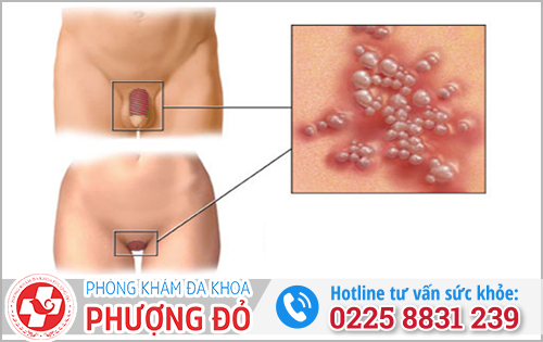 Mụn cóc sinh dục khác mụn rộp sinh dục ở điểm nào?