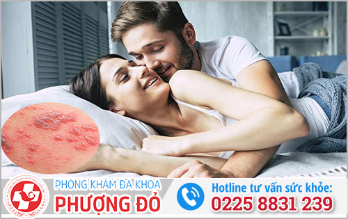 Bệnh herpes lây qua đường nào