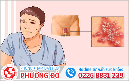 Cách phòng tránh lây nhiễm mụn rộp sinh dục