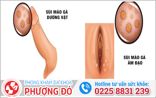 Sùi mào gà là bệnh gì?
