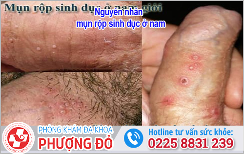 Nguyên nhân mụn rộp sinh dục